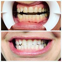 GloWhiteningatKaurDentalPittsburgh