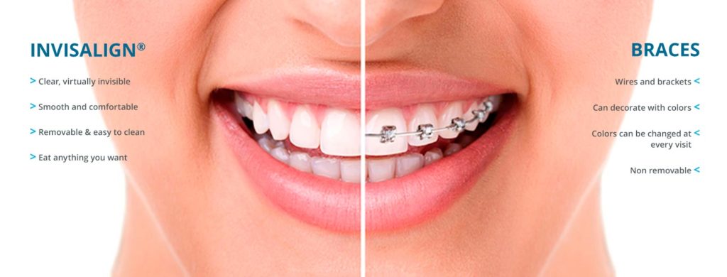 Invisalign-vs-Braces-Pittsburgh