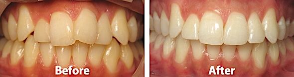 Fix Teeth Overcrowding in Pittsburgh